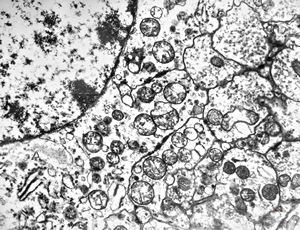 F,24y. | gangliocytoma F,24y. | gangliocytoma